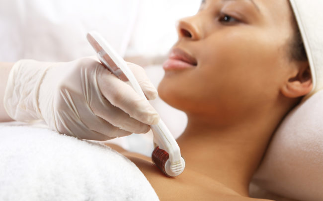 Microneedling